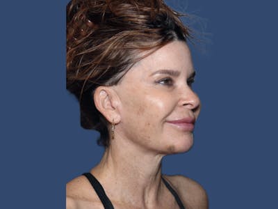 Neck Lift Before & After Gallery - Patient 309901 - Image 2