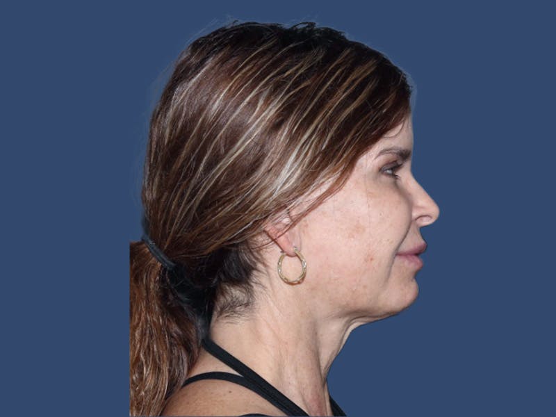 Neck Lift Before & After Gallery - Patient 309901 - Image 3