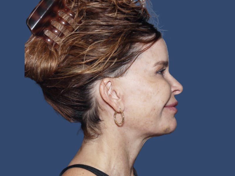 Neck Lift Before & After Gallery - Patient 309901 - Image 4