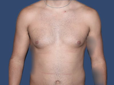 Gynecomastia Before & After Gallery - Patient 927917 - Image 1