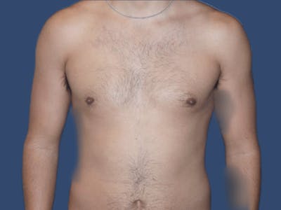 Gynecomastia Before & After Gallery - Patient 927917 - Image 2
