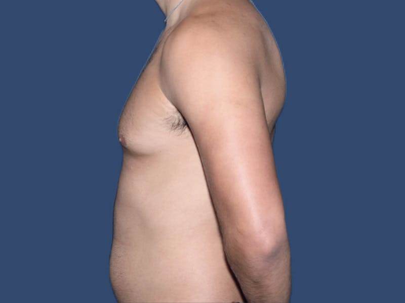 Gynecomastia Before & After Gallery - Patient 927917 - Image 3