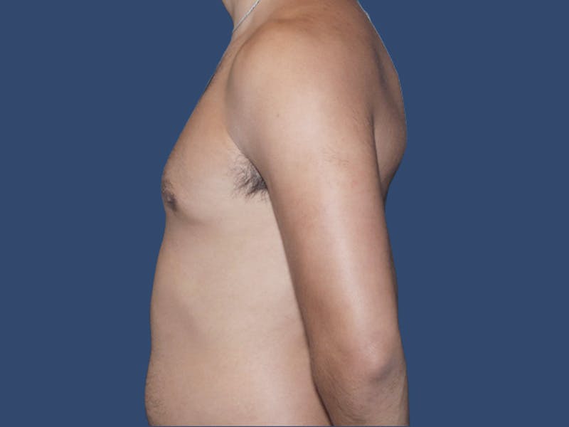 Gynecomastia Before & After Gallery - Patient 927917 - Image 4