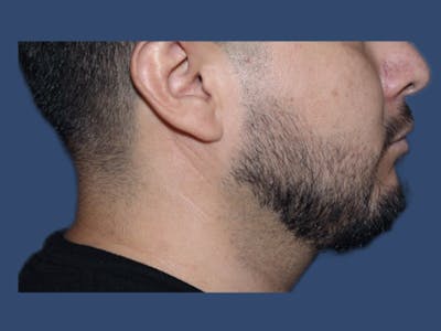 Facial Implant Before & After Gallery - Patient 555253 - Image 1