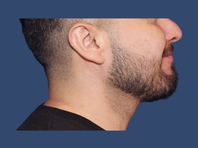 Facial Implant Before & After Gallery - Patient 555253 - Image 2