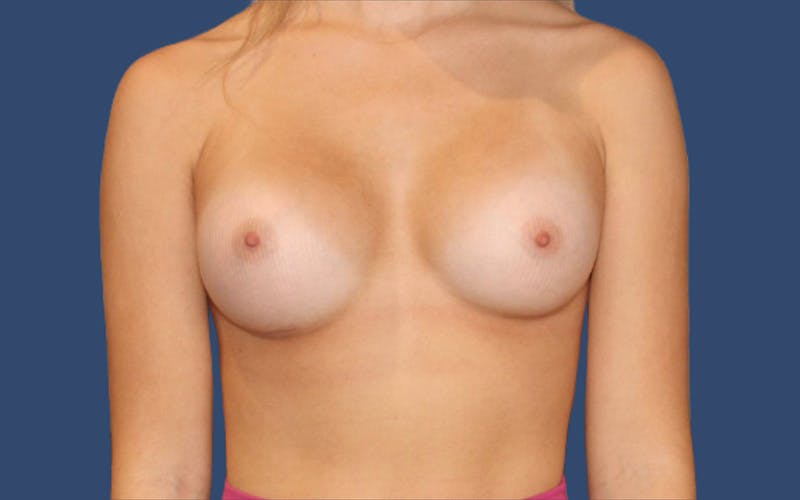 Breast Augmentation Before & After Gallery - Patient 320731 - Image 2