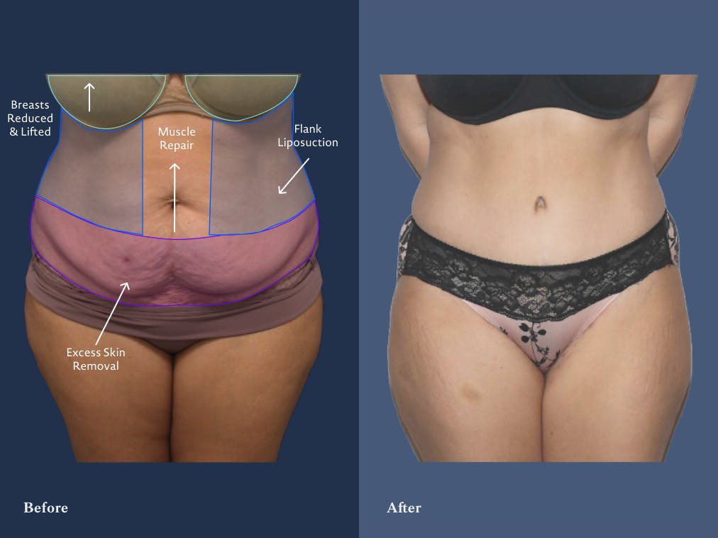 Tummy Tuck in San Antonio Hill Country Plastic Surgery