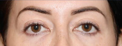 Eyelid Surgery Before & After Gallery - Patient 312222 - Image 1
