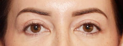 Eyelid Surgery Before & After Gallery - Patient 312222 - Image 2