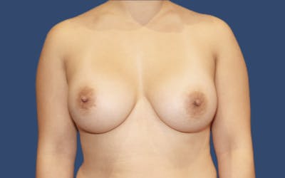 Breast Augmentation Before & After Gallery - Patient 340200 - Image 2