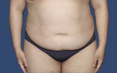 Tummy Tuck Before & After Gallery - Patient 764488 - Image 1