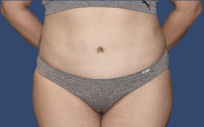 Tummy Tuck Before & After Gallery - Patient 764488 - Image 2