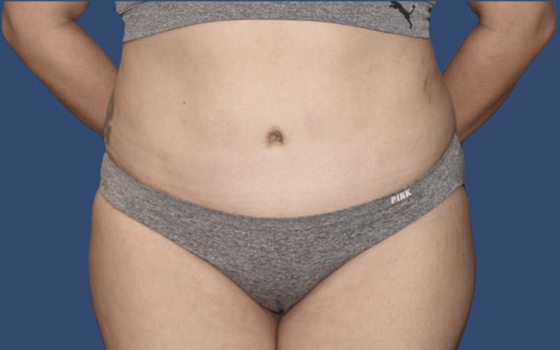 Tummy Tuck Before & After Gallery - Patient 764488 - Image 2