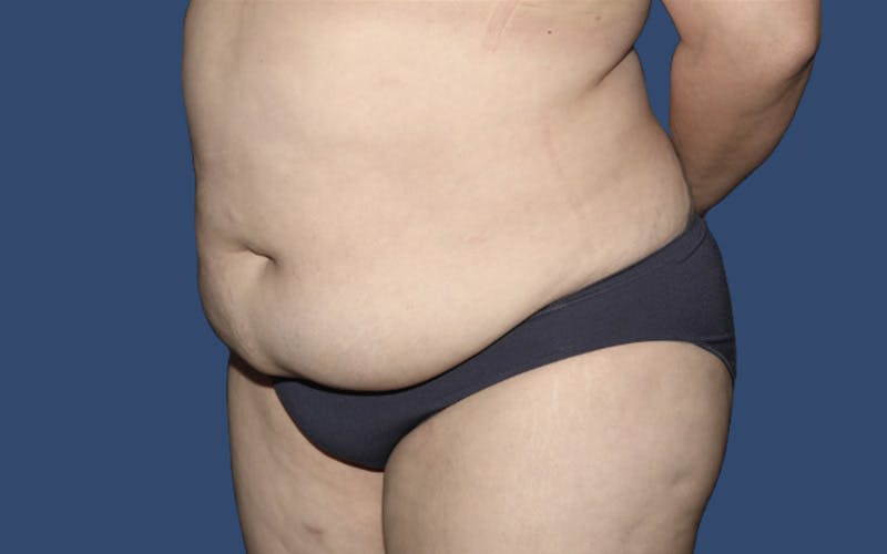 Tummy Tuck Before & After Gallery - Patient 764488 - Image 3