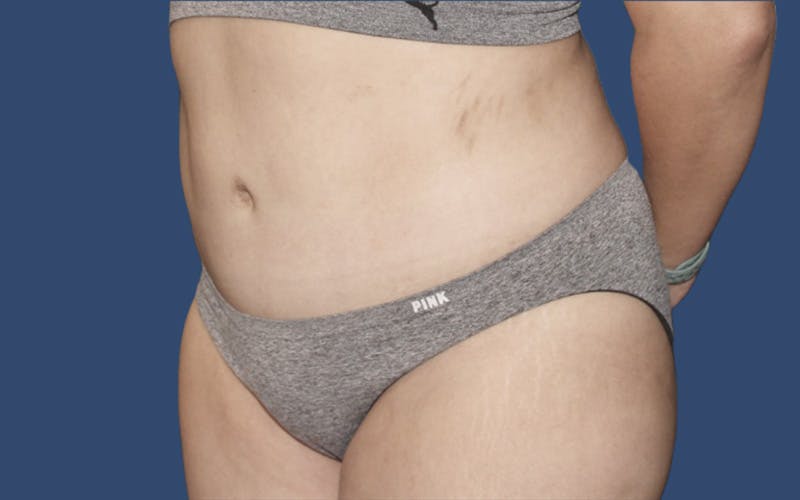 Tummy Tuck Before & After Gallery - Patient 764488 - Image 4