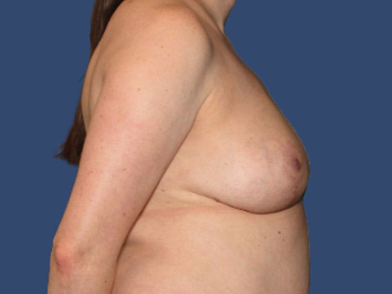 Breast Lift Before & After Gallery - Patient 229231 - Image 4