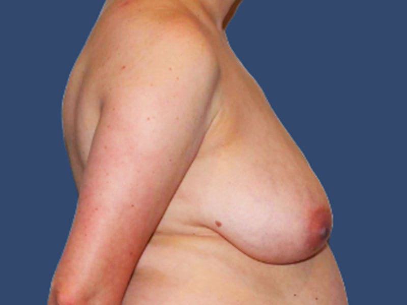 Breast Lift Before & After Gallery - Patient 229231 - Image 3