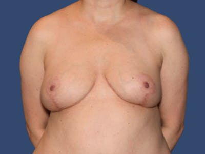Breast Lift Before & After Gallery - Patient 229231 - Image 2
