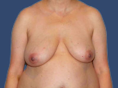 Breast Lift Before & After Gallery - Patient 229231 - Image 1