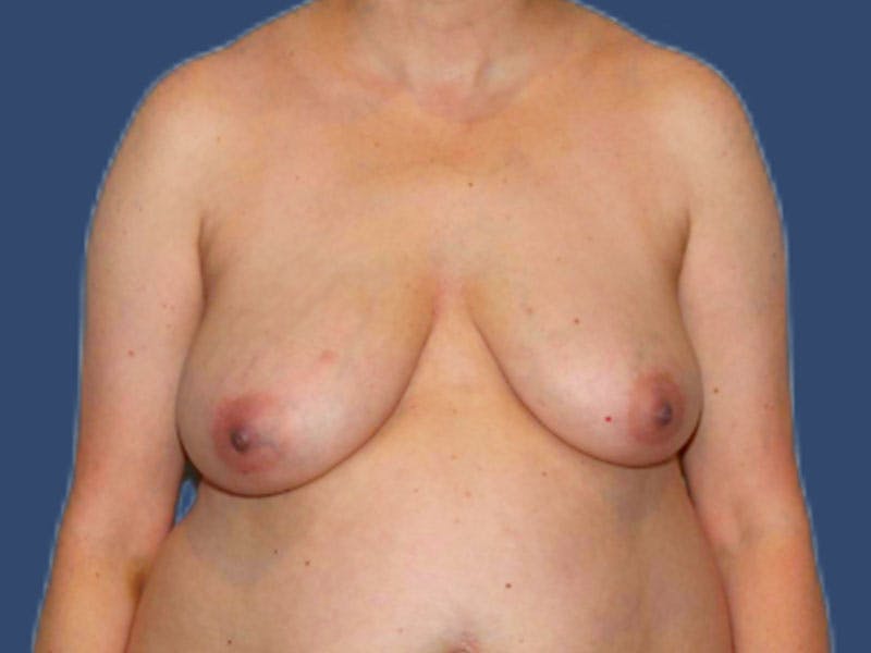 Breast Lift Before & After Gallery - Patient 229231 - Image 1