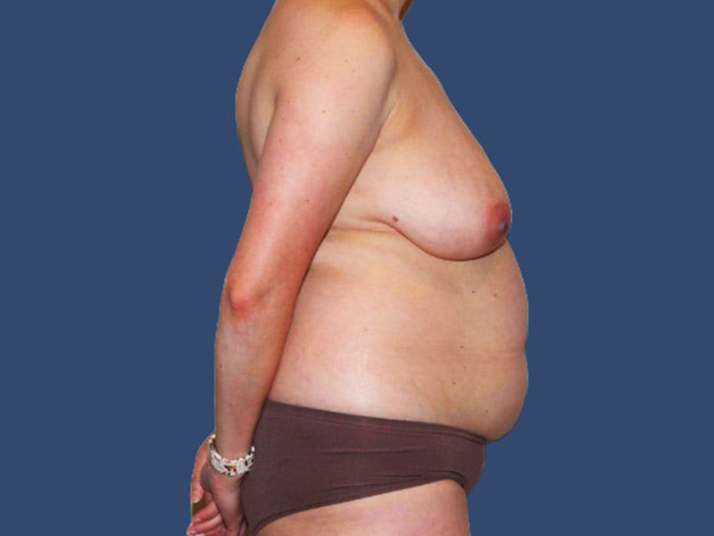 Mommy Makeover Before & After Gallery - Patient 129755 - Image 3