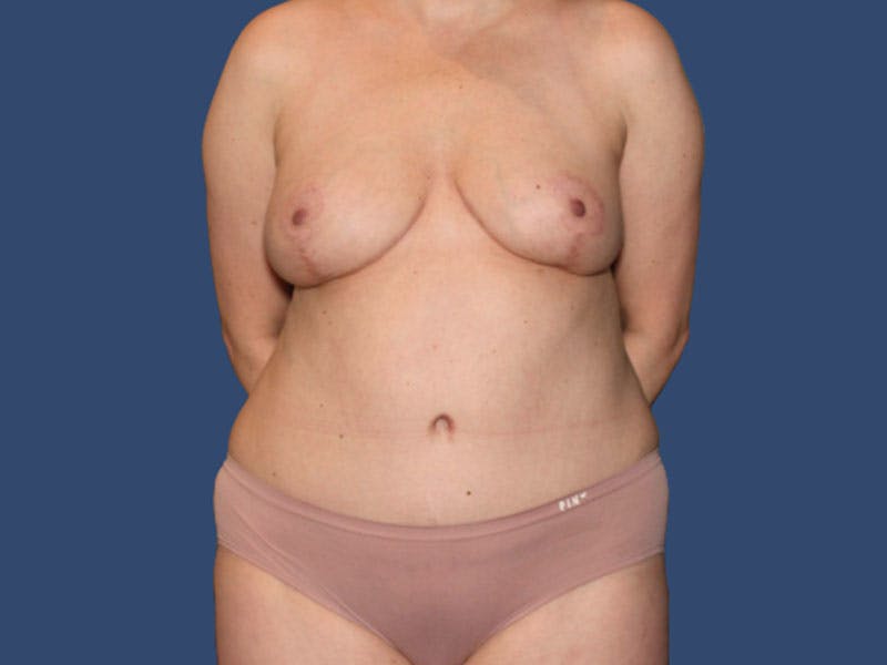 Mommy Makeover Before & After Gallery - Patient 129755 - Image 2