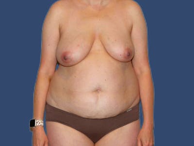 Mommy Makeover Before & After Gallery - Patient 129755 - Image 1