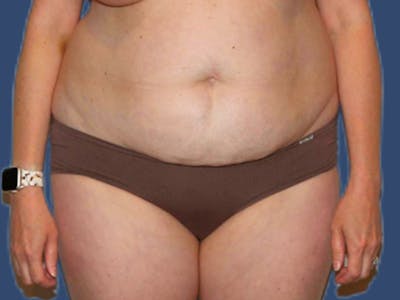Tummy Tuck Before & After Gallery - Patient 303720 - Image 1