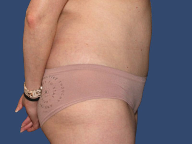 Tummy Tuck Before & After Gallery - Patient 303720 - Image 4