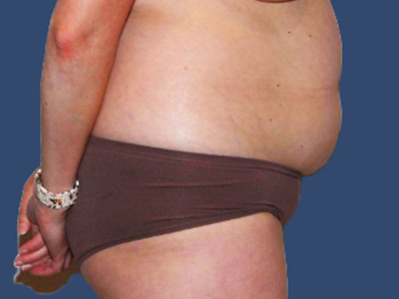 Tummy Tuck Before & After Gallery - Patient 303720 - Image 3