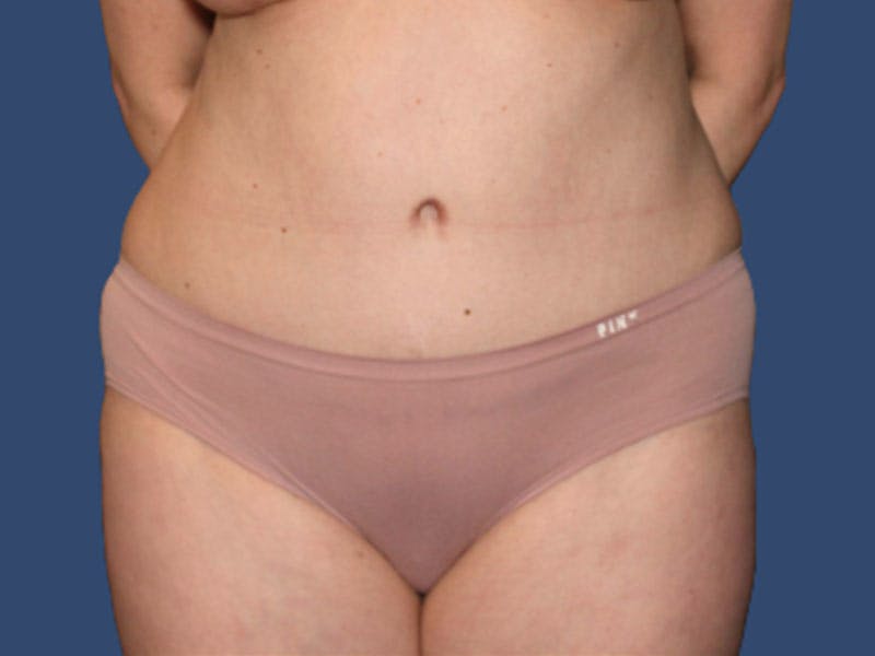 Tummy Tuck Before & After Gallery - Patient 303720 - Image 2