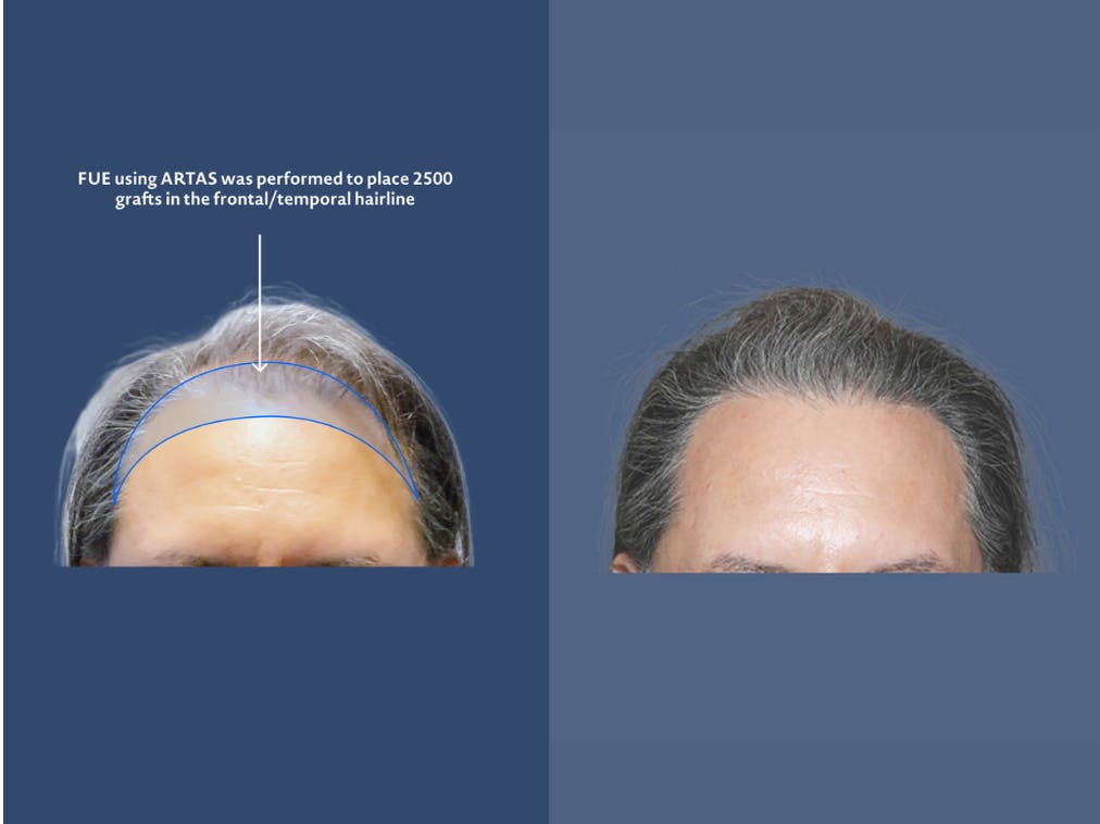 hair transplant infographic