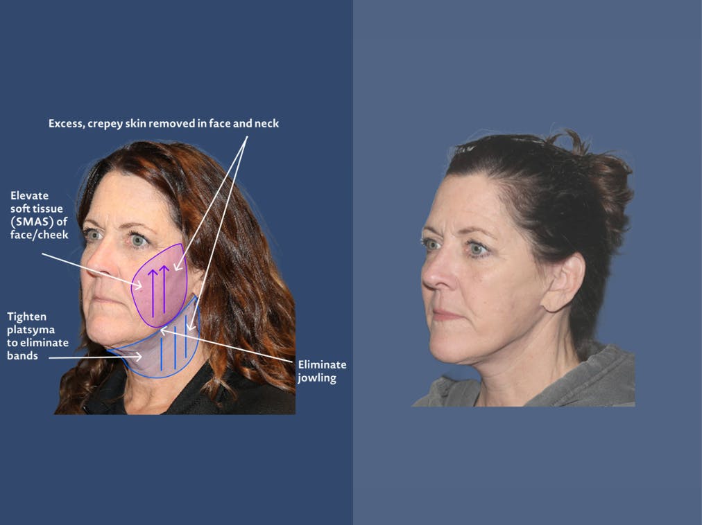 facelift before and after infographic