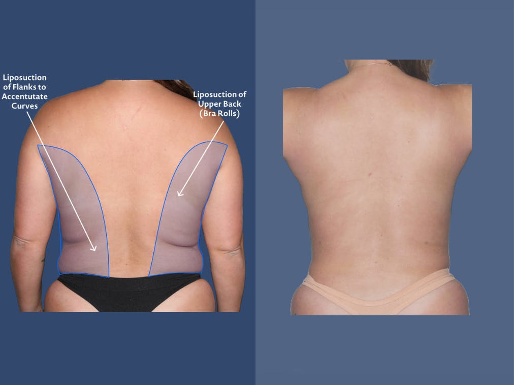 Liposuction before and after infographic