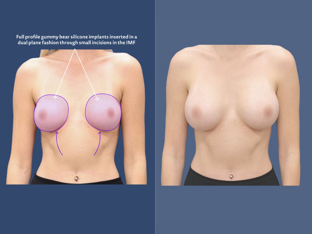 breast augmentation infographic