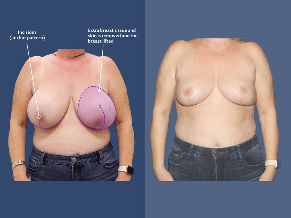 breast reduction infographic
