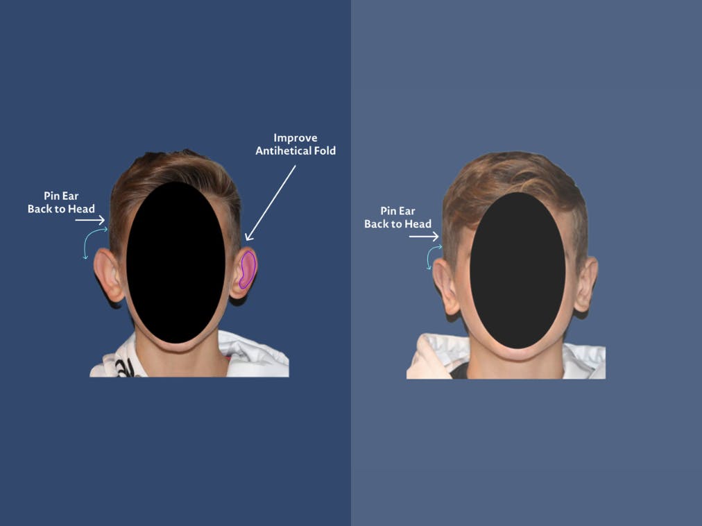 Otoplasty before and after infographic