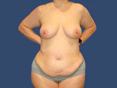 Tummy Tuck Before & After Gallery - Patient 171039 - Image 1