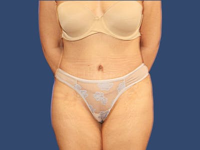 Tummy Tuck Before & After Gallery - Patient 171039 - Image 2