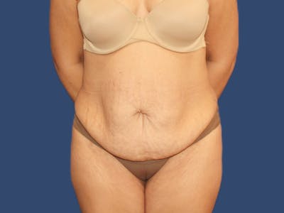 Tummy Tuck Before & After Gallery - Patient 171039 - Image 1