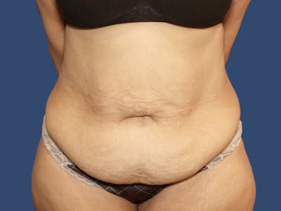 Tummy Tuck Before & After Gallery - Patient 270179 - Image 1