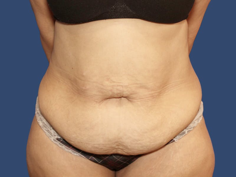 Tummy Tuck Before & After Gallery - Patient 270179 - Image 1