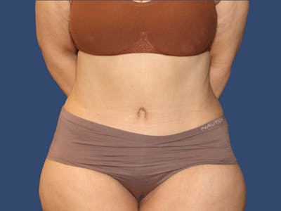 Tummy Tuck Before & After Gallery - Patient 270179 - Image 2