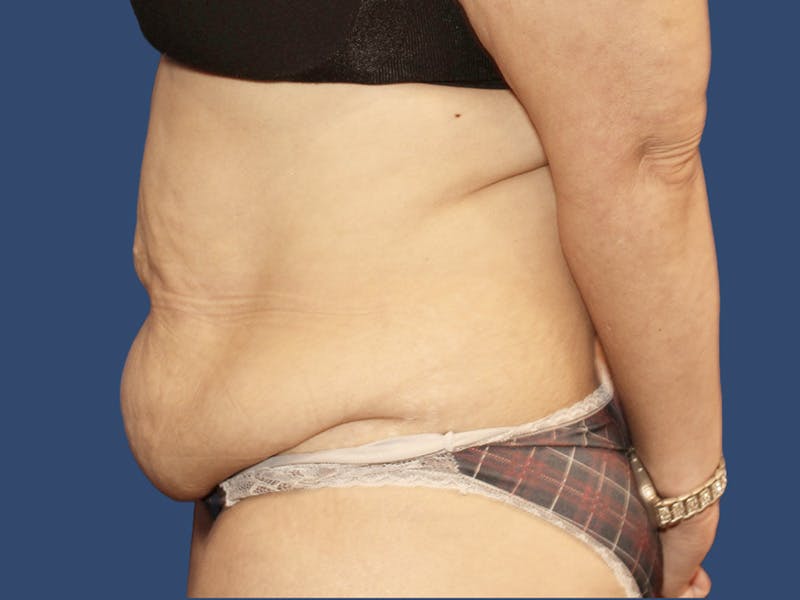 Tummy Tuck Before & After Gallery - Patient 270179 - Image 3