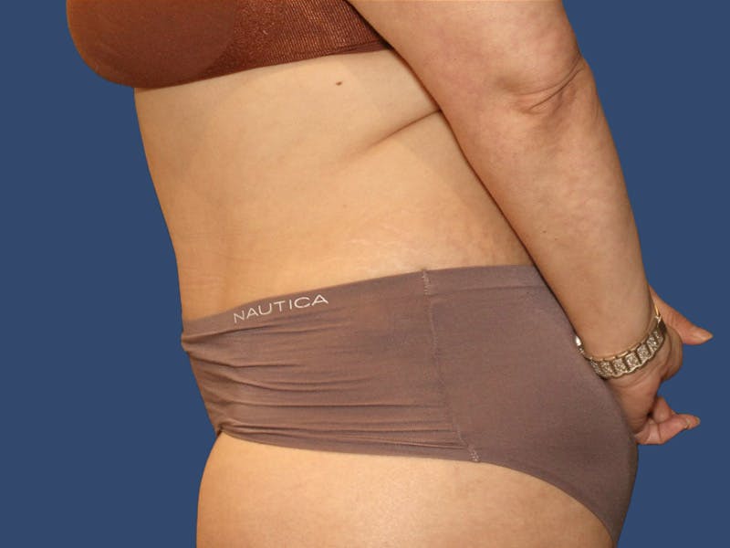 Tummy Tuck Before & After Gallery - Patient 270179 - Image 4