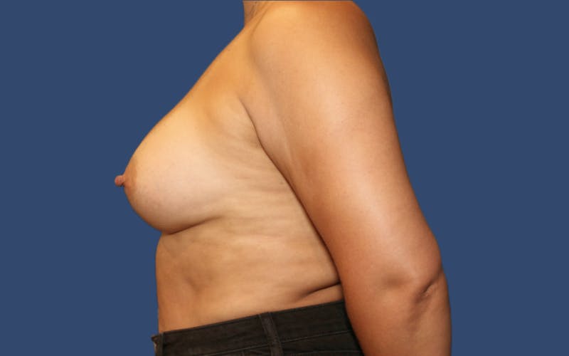 Breast Augmentation Before & After Gallery - Patient 942859 - Image 4