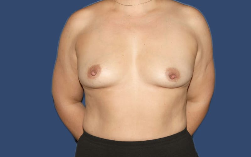 Breast Augmentation Before & After Gallery - Patient 942859 - Image 1