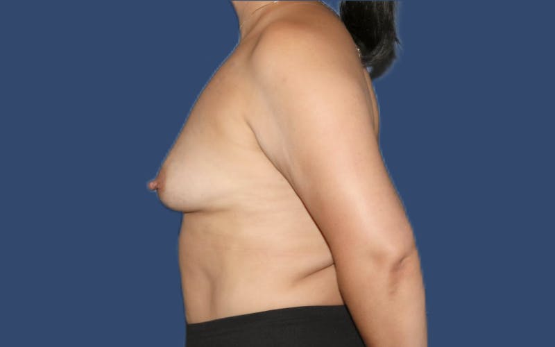 Breast Augmentation Before & After Gallery - Patient 942859 - Image 3