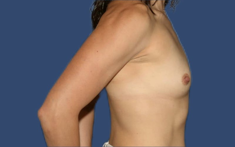 Breast Augmentation Before & After Gallery - Patient 368079 - Image 3
