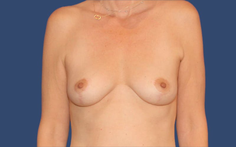 Breast Augmentation Before & After Gallery - Patient 277237 - Image 1